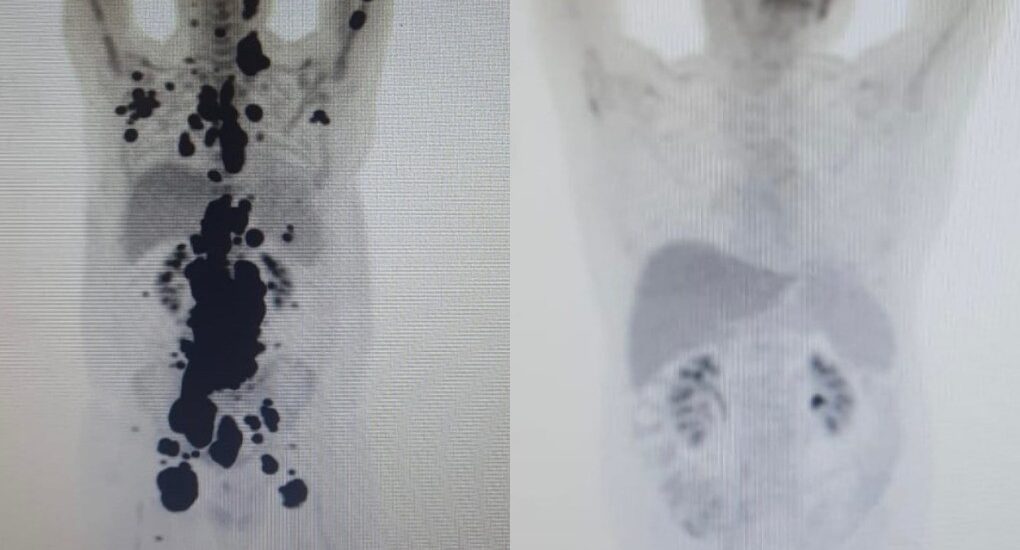 Cientista em laboratório de biotecnologia analisando amostras de sangue para terapia celular avançada.