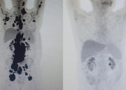 Cientista em laboratório de biotecnologia analisando amostras de sangue para terapia celular avançada.